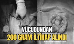 200 gram iltihap ameliyatla alındı