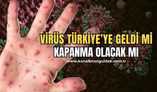 Kısıtlama gelecek mi? Sağlık Bakanlığı'ndan 'M çiçeği (mpox) hastalığı' açıklaması!