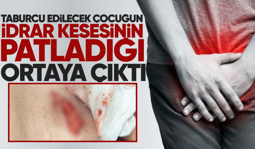 Taburcu edilmek istenen çocuğun idrar kesesinin patladığı ortaya çıktı
